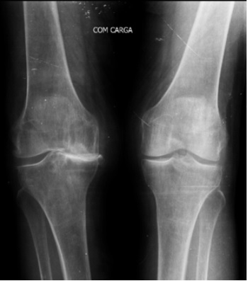 dr-lucas-cordeiro-ortopedista-joelho