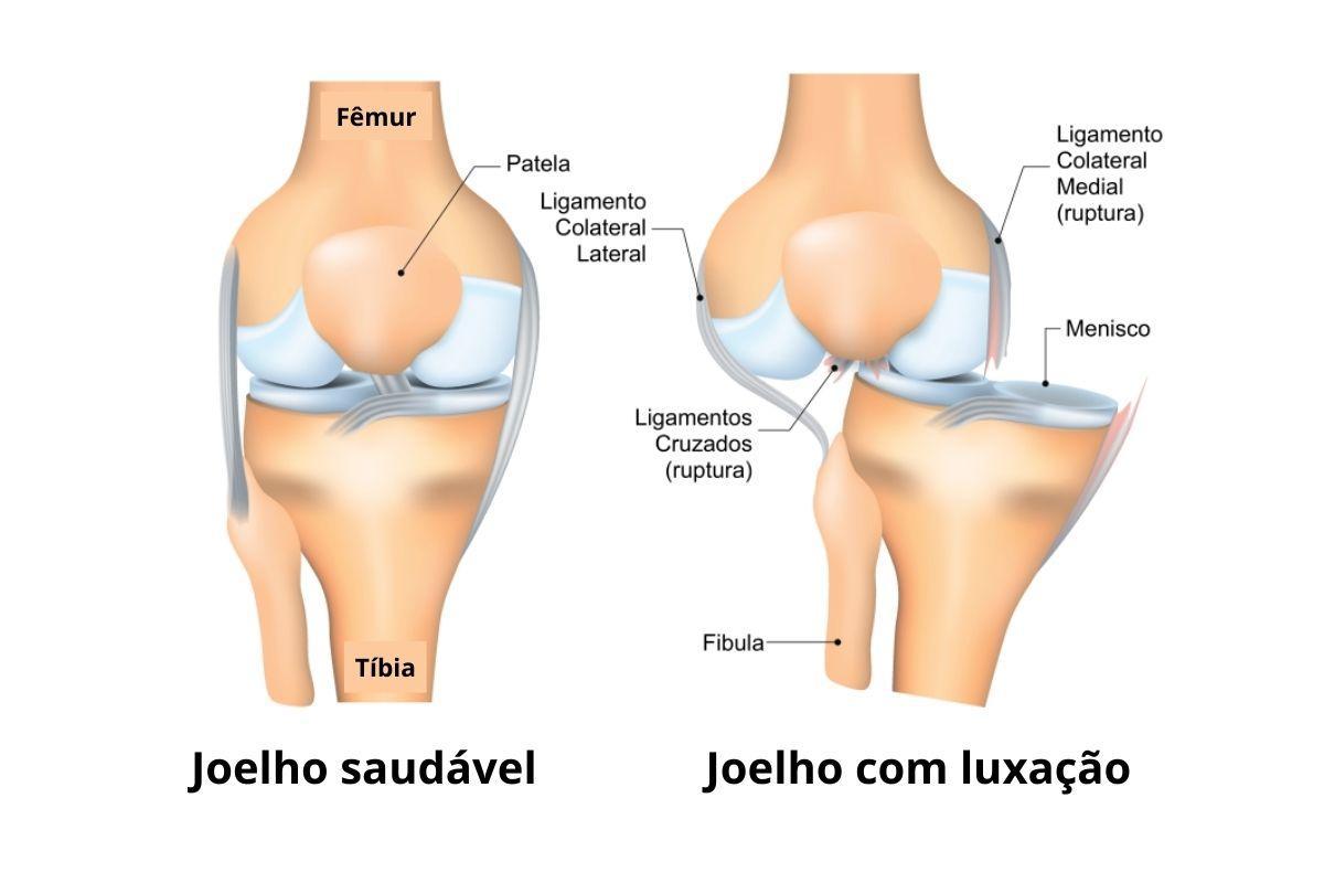 joelho-luxado-dr-lucas-cordeiro-ortopedista-sao-paulo